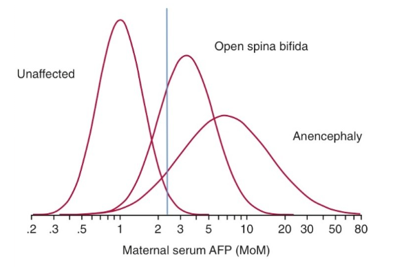 Graph with maternal serum AFP on the x-axis, ranging from .2 to 80, and three bell curves, all overlapping, but with means of approximately 1, 4, and 8, respectively, labeled 'Unaffected', 'Open spina bifida', and 'Anancephaly'. There is a vertical line on the graph at 2.5.